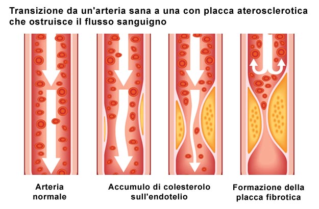 Placca aterosclerotica che ostruisce il flusso sanguigno