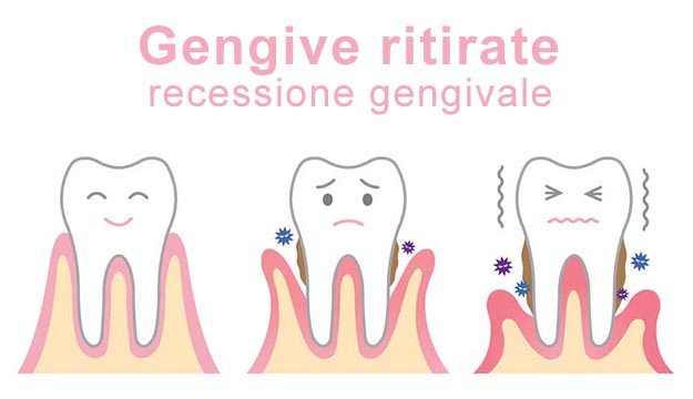 Sintomi gengive ritirate: sensibilità dentale Gengive ritirate