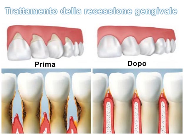 Gengive ritirate tornano normali dopo intervento Recessione gengivale intervento