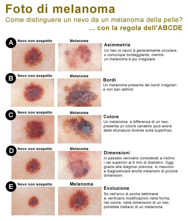 Melanoma foto