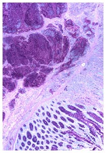 Cellule tumorali nel colon-retto